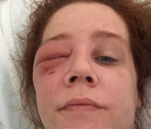 2018 Orbital cellulitis